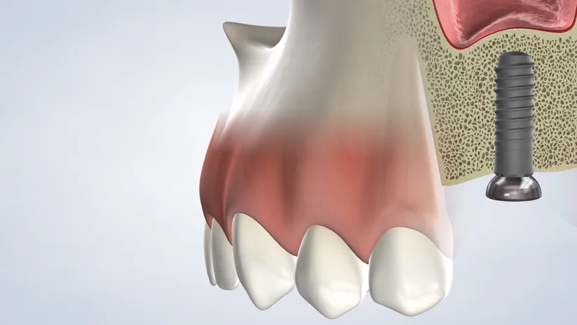 Bone grafting in Fresno, Clovis, Reedley, and Madera, CA