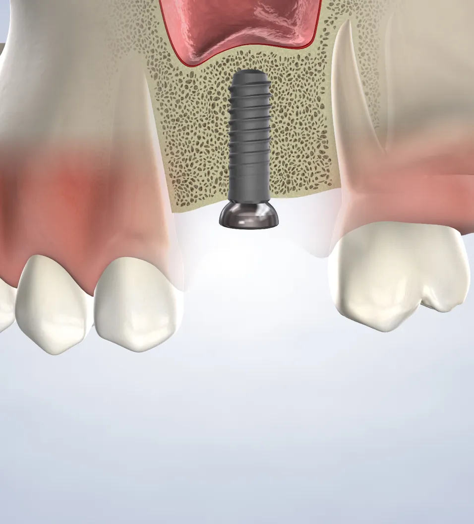Bone grafting in Fresno, Clovis, Reedley, and Madera, CA
