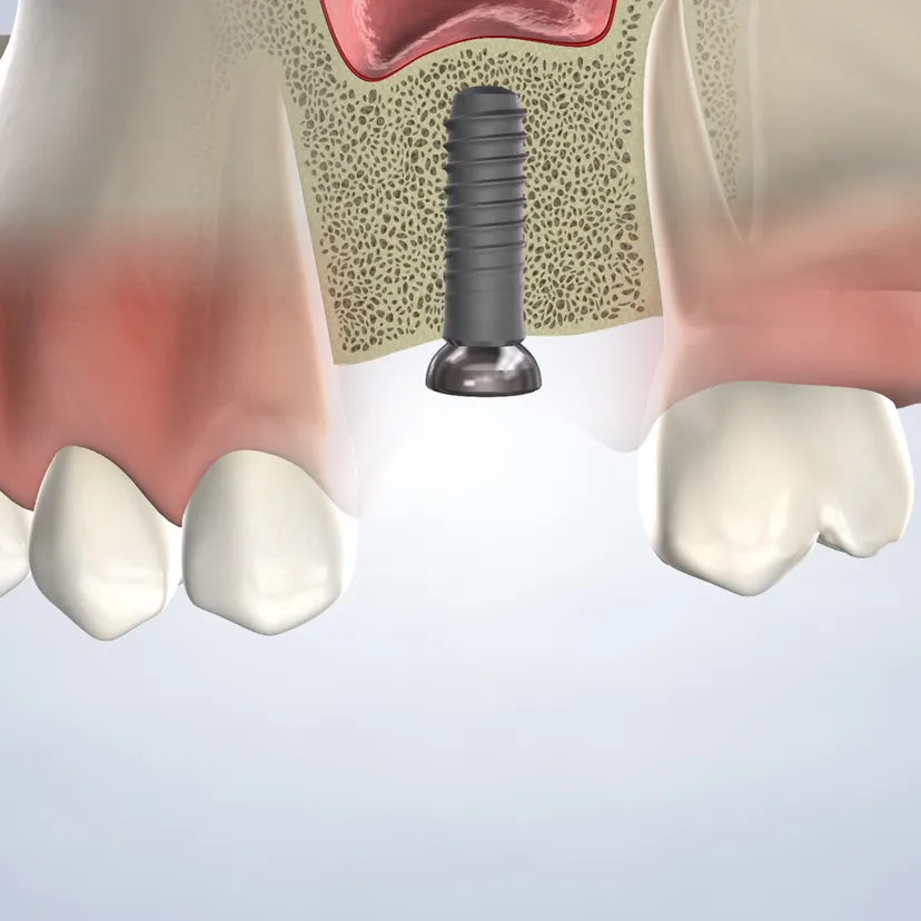 Bone grafting in Fresno, Clovis, Reedley, and Madera, CA