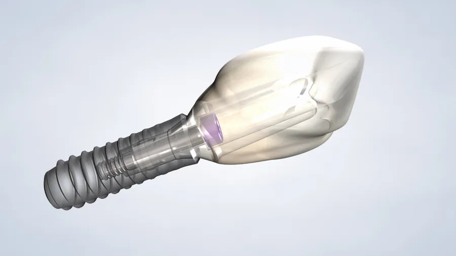 Dental implants in Fresno, Clovis, Reedley, and Madera, CA