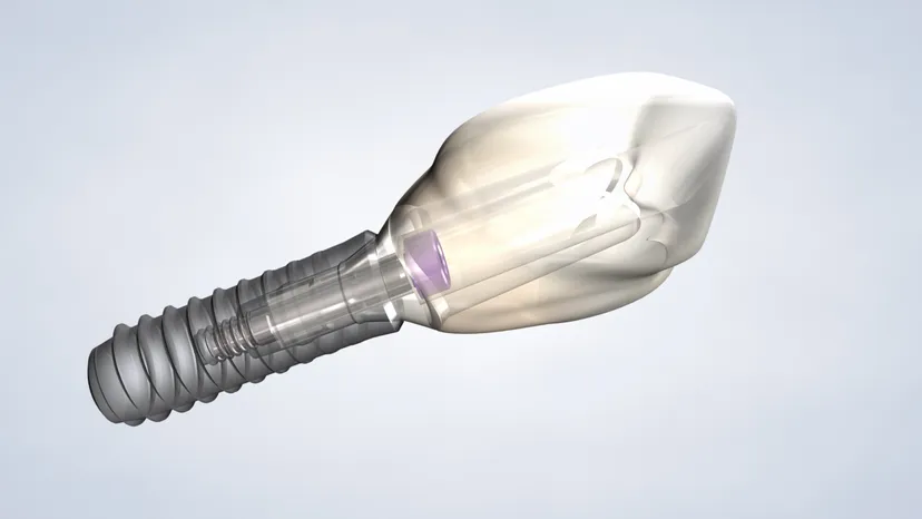 Dental implants in Fresno, Clovis, Reedley, and Madera, CA