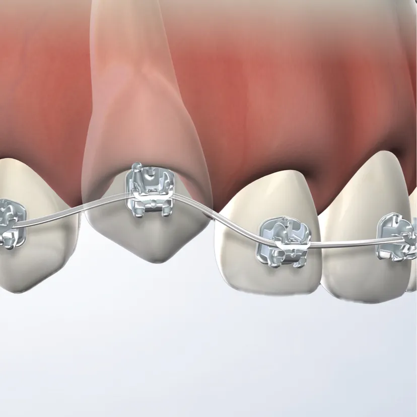 Tooth exposure in Fresno, Clovis, Reedley, and Madera, CA