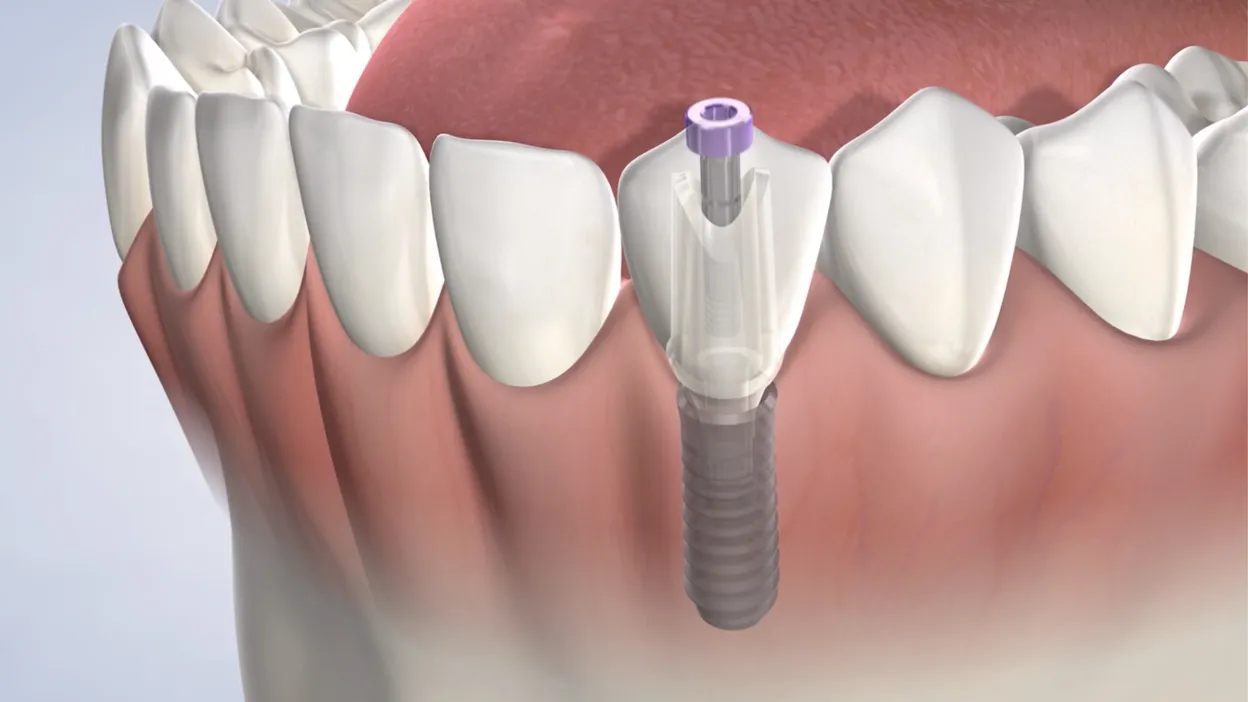 Instruction dental implant