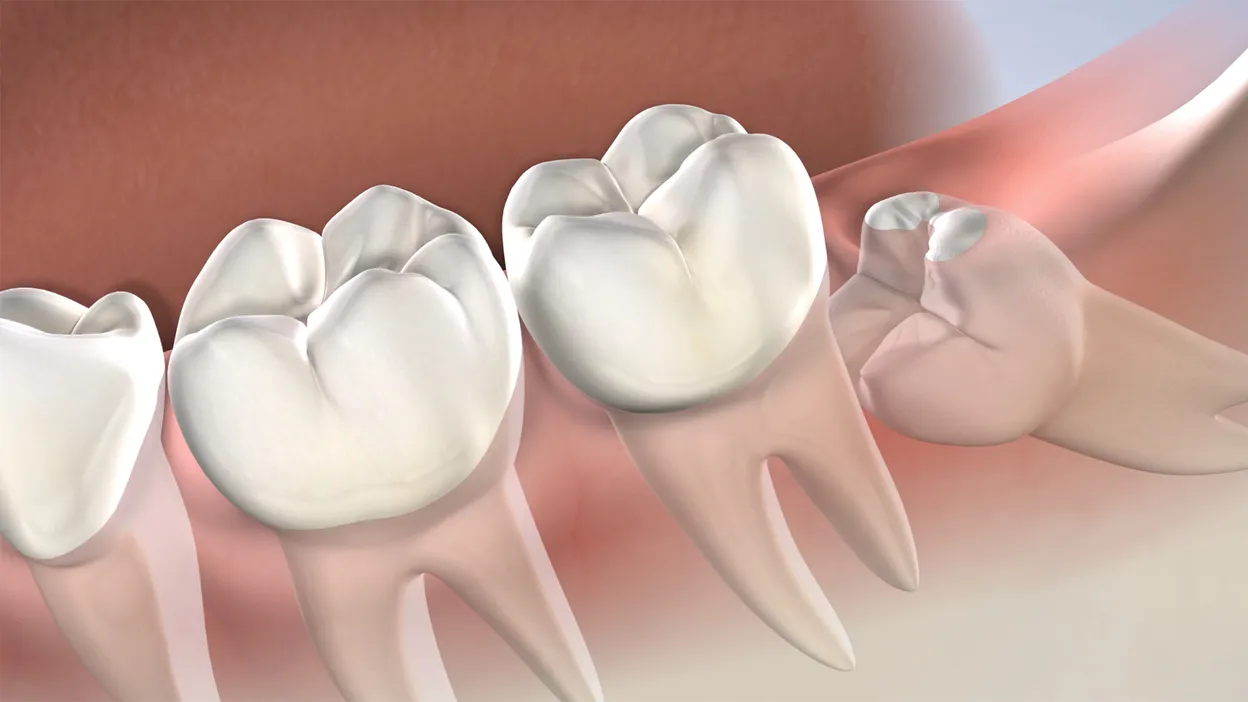 Instructions wisdom teeth
