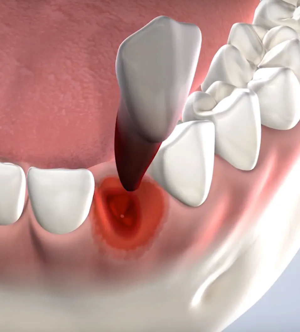 Tooth extractions in Fresno, Clovis, Reedley, and Madera, CA