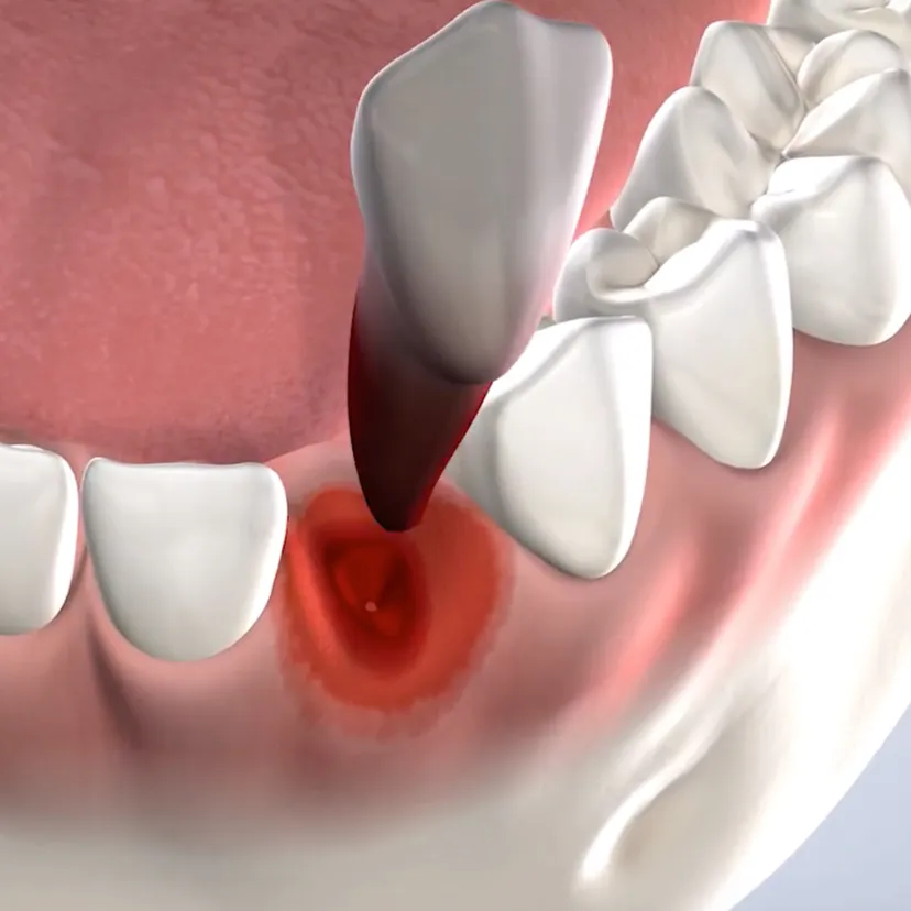 Tooth extractions in Fresno, Clovis, Reedley, and Madera, CA