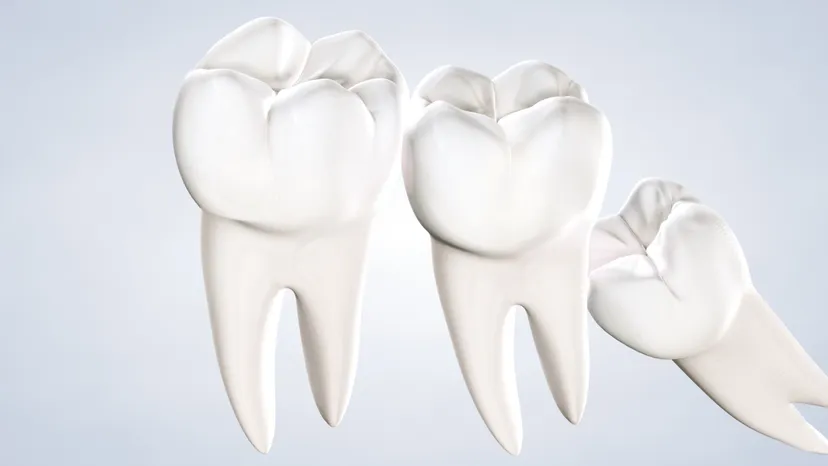 Wisdom teeth removal in Fresno, Clovis, Reedley, and Madera, CA