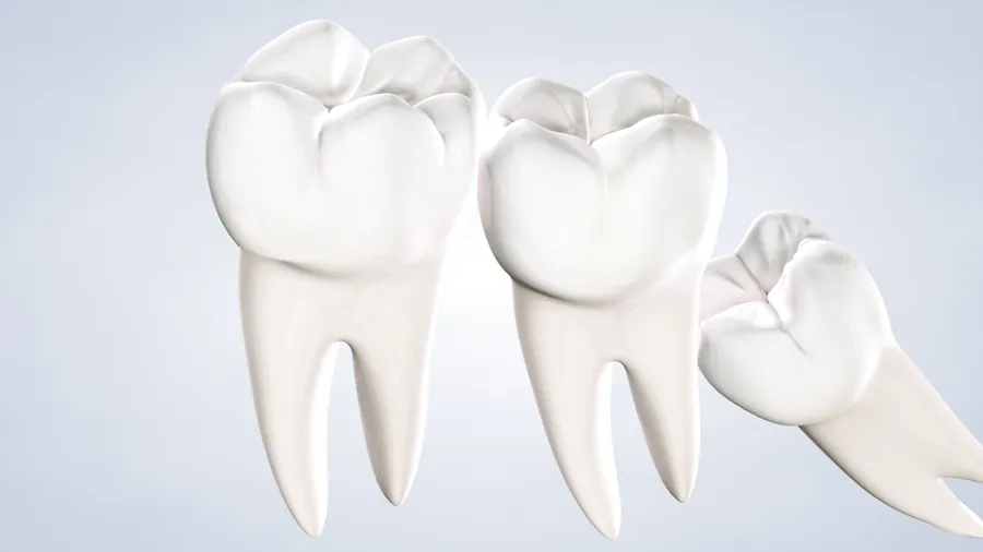 Wisdom teeth removal in Fresno, Clovis, Reedley, and Madera, CA
