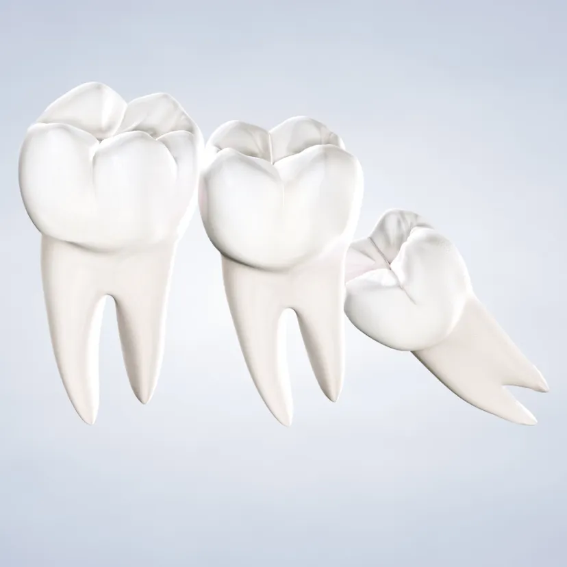 Wisdom teeth removal in Fresno, Clovis, Reedley, and Madera, CA