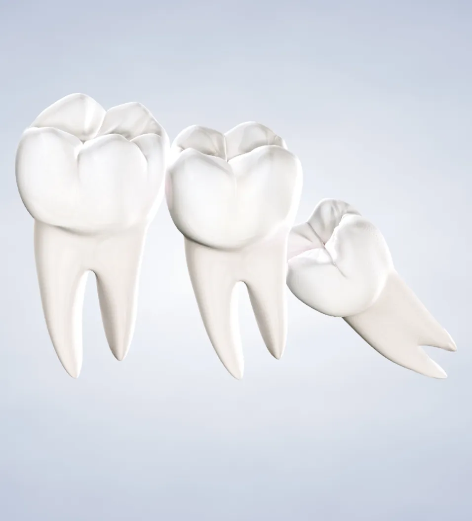 Wisdom teeth removal in Fresno, Clovis, Reedley, and Madera, CA
